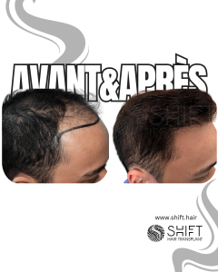 Avant Après de Greffe de Cheveux pour Calvitie Norwood 4 en Turquie chez SHIFT Hair à Istanbul 21 3