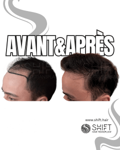 Avant Après de Greffe de Cheveux pour Calvitie Norwood 4 en Turquie chez SHIFT Hair à Istanbul 22 3