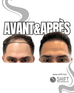 Avant Après de Greffe de Cheveux pour Calvitie Norwood 4 en Turquie chez SHIFT Hair à Istanbul 23 3