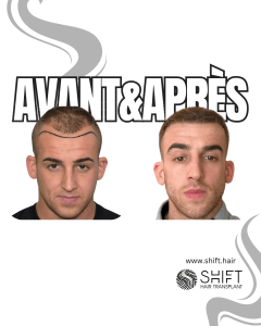 Avant Après de Greffe de Cheveux pour Calvitie Norwood 4 en Turquie chez SHIFT Hair à Istanbul 25 3