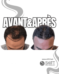 Avant Après de Greffe de Cheveux pour Calvitie Norwood 5 en Turquie chez SHIFT Hair à Istanbul 01 3