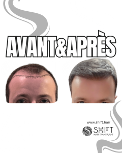 Avant Après de Greffe de Cheveux pour Calvitie Norwood 5 en Turquie chez SHIFT Hair à Istanbul 05 3