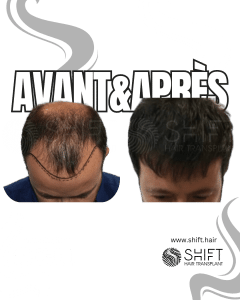 Avant Après de Greffe de Cheveux pour Calvitie Norwood 5 en Turquie chez SHIFT Hair à Istanbul 06 3