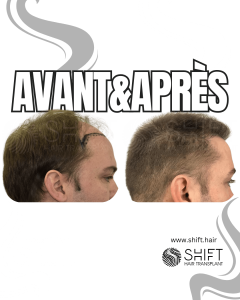 Avant Après de Greffe de Cheveux pour Calvitie Norwood 5 en Turquie chez SHIFT Hair à Istanbul 09 3