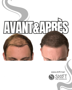 Avant Après de Greffe de Cheveux pour Calvitie Norwood 5 en Turquie chez SHIFT Hair à Istanbul 10 3