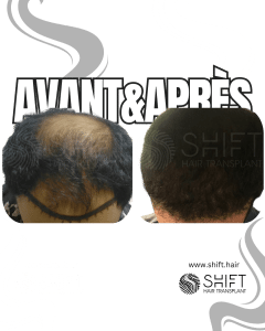 Avant Après de Greffe de Cheveux pour Calvitie Norwood 5 en Turquie chez SHIFT Hair à Istanbul 11 3