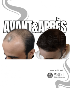 Avant Après de Greffe de Cheveux pour Calvitie Norwood 5 en Turquie chez SHIFT Hair à Istanbul 12 3