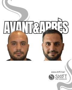 Avant Après de Greffe de Cheveux pour Calvitie Norwood 5 en Turquie chez SHIFT Hair à Istanbul 13 3