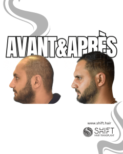 Avant Après de Greffe de Cheveux pour Calvitie Norwood 5 en Turquie chez SHIFT Hair à Istanbul 16 3