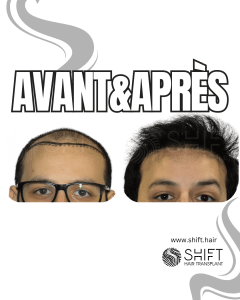 Avant Après de Greffe de Cheveux pour Calvitie Norwood 6 en Turquie chez SHIFT Hair à Istanbul 01 3