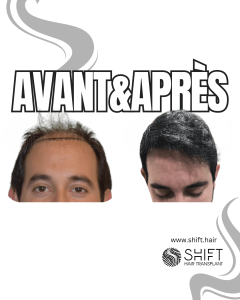 Avant Après de Greffe de Cheveux pour Calvitie Norwood 6 en Turquie chez SHIFT Hair à Istanbul 04 3