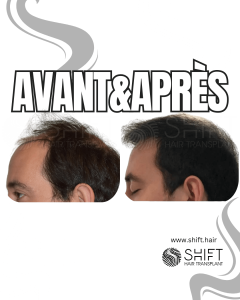 Avant Après de Greffe de Cheveux pour Calvitie Norwood 6 en Turquie chez SHIFT Hair à Istanbul 05 3