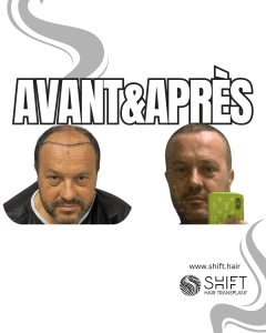 Avant Après de Greffe de Cheveux pour Calvitie Norwood 6 en Turquie chez SHIFT Hair à Istanbul 06 3