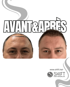 Avant Après de Greffe de Cheveux pour Calvitie Norwood 6 en Turquie chez SHIFT Hair à Istanbul 07 3