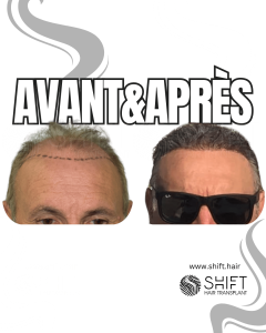 Avant Après de Greffe de Cheveux pour Calvitie Norwood 6 en Turquie chez SHIFT Hair à Istanbul 09 3