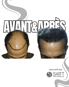 Avant Après de Greffe de Cheveux pour Calvitie Norwood 6 en Turquie chez SHIFT Hair à Istanbul 10 3