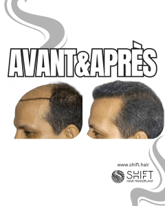 Avant Après de Greffe de Cheveux pour Calvitie Norwood 6 en Turquie chez SHIFT Hair à Istanbul 11 3