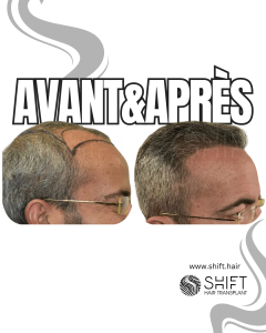 Avant Après de Greffe de Cheveux pour Calvitie Norwood 6 en Turquie chez SHIFT Hair à Istanbul 12 3