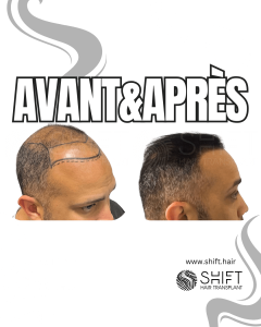 Avant Après de Greffe de Cheveux pour Calvitie Norwood 6 en Turquie chez SHIFT Hair à Istanbul 13 3