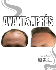 Avant Après de Greffe de Cheveux pour Calvitie Norwood 6 en Turquie chez SHIFT Hair à Istanbul 14 3