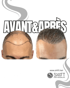 Avant Après de Greffe de Cheveux pour Calvitie Norwood 6 en Turquie chez SHIFT Hair à Istanbul 15 3