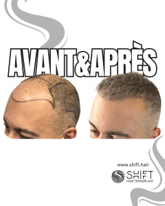 Avant Après de Greffe de Cheveux pour Calvitie Norwood 6 en Turquie chez SHIFT Hair à Istanbul 16 3