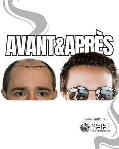Avant Après de Greffe de Cheveux pour Calvitie Norwood 6 en Turquie chez SHIFT Hair à Istanbul 17 3
