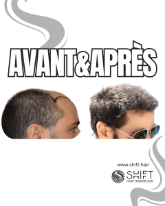 Avant Après de Greffe de Cheveux pour Calvitie Norwood 6 en Turquie chez SHIFT Hair à Istanbul 18 3