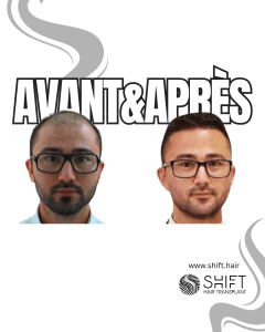 Avant Après de Greffe de Cheveux pour Calvitie Norwood 7 en Turquie chez SHIFT Hair à Istanbul 01 3
