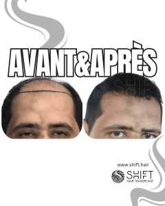 Avant Après de Greffe de Cheveux pour Calvitie Norwood 7 en Turquie chez SHIFT Hair à Istanbul 02 3