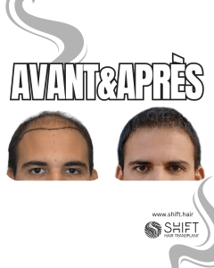 Avant Après de Greffe de Cheveux pour Calvitie Norwood 7 en Turquie chez SHIFT Hair à Istanbul 03 3