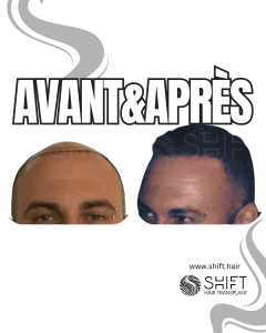 Avant Après de Greffe de Cheveux pour Calvitie Norwood 7 en Turquie chez SHIFT Hair à Istanbul 04 3