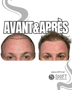Avant Après de Greffe de Cheveux pour Calvitie Norwood 7 en Turquie chez SHIFT Hair à Istanbul 05 3