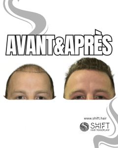 Avant Après de Greffe de Cheveux pour Calvitie Norwood 7 en Turquie chez SHIFT Hair à Istanbul 07 3