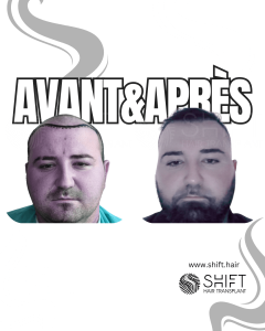Avant Après de Greffe de Cheveux pour Calvitie Norwood 7 en Turquie chez SHIFT Hair à Istanbul 08 3