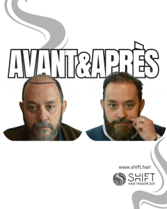 Avant Après de Greffe de Cheveux pour Calvitie Norwood 7 en Turquie chez SHIFT Hair à Istanbul 09 3