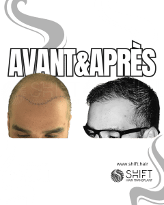 Avant Après de Greffe de Cheveux pour Calvitie Norwood 7 en Turquie chez SHIFT Hair à Istanbul 11 3