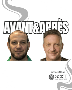 Avant Après de Greffe de Cheveux pour Calvitie Norwood 7 en Turquie chez SHIFT Hair à Istanbul 12 3