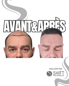 Avant Après de Greffe de Cheveux pour Calvitie Norwood 7 en Turquie chez SHIFT Hair à Istanbul 13 3