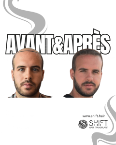 Avant Après de Greffe de Cheveux pour Calvitie Norwood 7 en Turquie chez SHIFT Hair à Istanbul 14 3