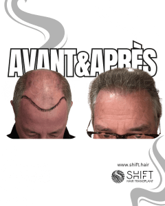 Avant Après de Greffe de Cheveux pour Calvitie Norwood 7 en Turquie chez SHIFT Hair à Istanbul 15 3