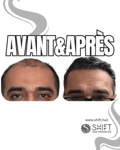 Avant Après de Greffe de Cheveux pour Calvitie Norwood 7 en Turquie chez SHIFT Hair à Istanbul 16 3