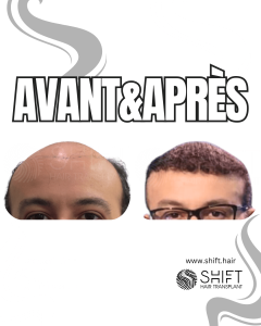 Avant Après de Greffe de Cheveux pour Calvitie Norwood 7 en Turquie chez SHIFT Hair à Istanbul 17 3