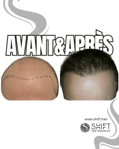 Avant Après de Greffe de Cheveux pour Calvitie Norwood 7 en Turquie chez SHIFT Hair à Istanbul 18 3