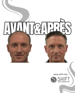 Avant Après de Greffe de Cheveux pour Calvitie Norwood 7 en Turquie chez SHIFT Hair à Istanbul 19 3
