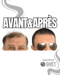 Avant Après de Greffe de Cheveux pour Calvitie Norwood 7 en Turquie chez SHIFT Hair à Istanbul 20 3