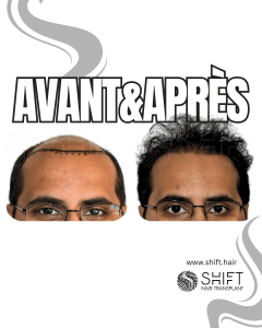 Avant Après de Greffe de Cheveux pour Calvitie Norwood 7 en Turquie chez SHIFT Hair à Istanbul 21 3