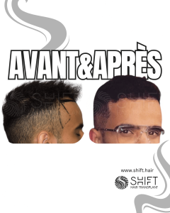Avant Après de la Greffe de Cheveux pour les Temples en Turquie chez SHIFT Hair à Istanbul 01 3
