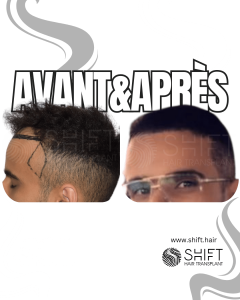 Avant Après de la Greffe de Cheveux pour les Temples en Turquie chez SHIFT Hair à Istanbul 02 3