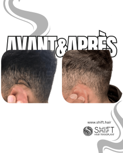 Avant Après de la Greffe de Cheveux sur Petite Zone en Turquie chez SHIFT Hair à Istanbul 01 3